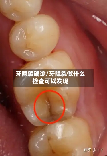 牙隐裂确诊/牙隐裂做什么检查可以发现-第3张图片