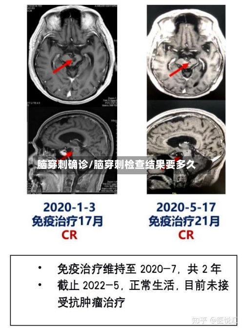 脑穿刺确诊/脑穿刺检查结果要多久-第2张图片