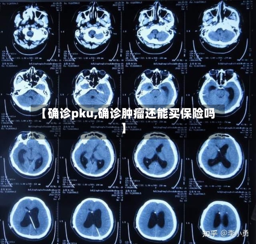 【确诊pku,确诊肿瘤还能买保险吗】-第2张图片