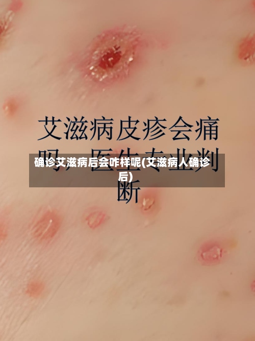 确诊艾滋病后会咋样呢(艾滋病人确诊后)-第2张图片