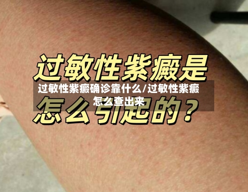 过敏性紫癜确诊靠什么/过敏性紫癜怎么查出来-第2张图片