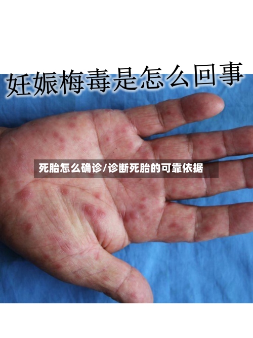死胎怎么确诊/诊断死胎的可靠依据