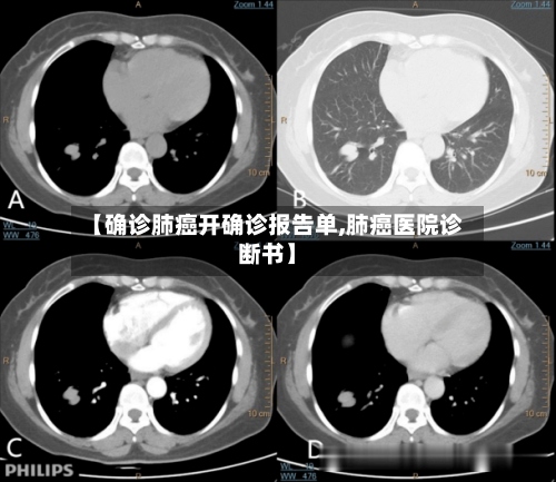 【确诊肺癌开确诊报告单,肺癌医院诊断书】-第3张图片