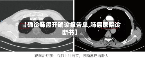 【确诊肺癌开确诊报告单,肺癌医院诊断书】-第2张图片