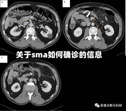 关于sma如何确诊的信息