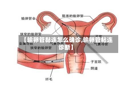 【输卵管黏连怎么确诊,输卵管粘连诊断】-第3张图片