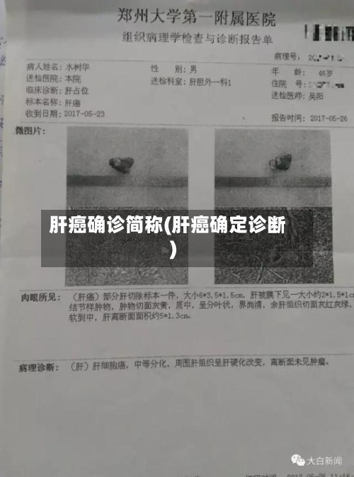 肝癌确诊简称(肝癌确定诊断)