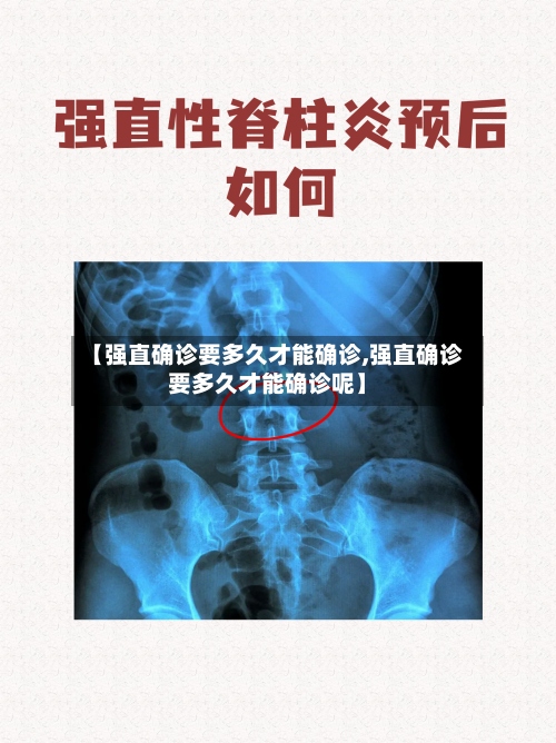 【强直确诊要多久才能确诊,强直确诊要多久才能确诊呢】