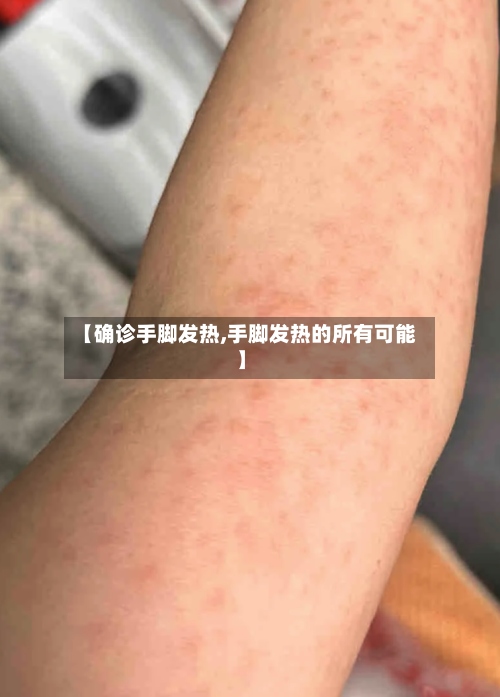 【确诊手脚发热,手脚发热的所有可能】