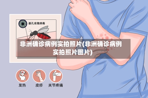 非洲确诊病例实拍照片(非洲确诊病例实拍照片图片)