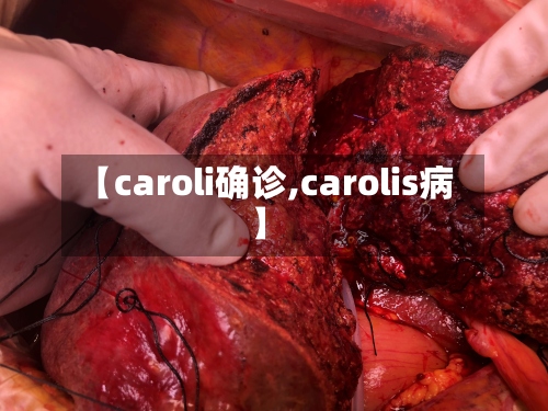 【caroli确诊,carolis病】