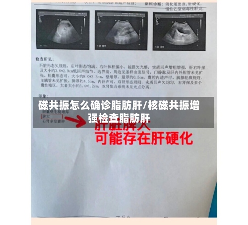磁共振怎么确诊脂肪肝/核磁共振增强检查脂肪肝-第2张图片