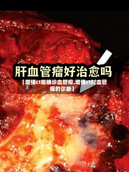 【增强ct能确诊血管瘤,增强ct对血管瘤的诊断】-第2张图片