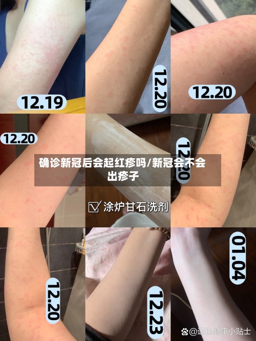确诊新冠后会起红疹吗/新冠会不会出疹子