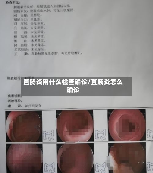 直肠炎用什么检查确诊/直肠炎怎么确诊