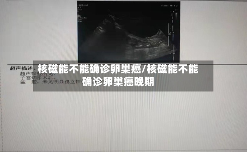 核磁能不能确诊卵巢癌/核磁能不能确诊卵巢癌晚期