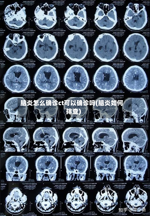 脑炎怎么确诊ct可以确诊吗(脑炎如何排查)