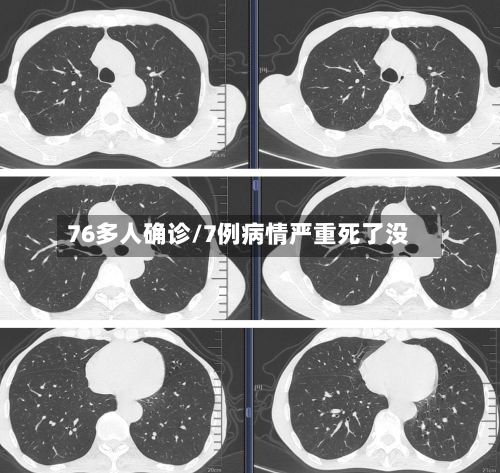 76多人确诊/7例病情严重死了没-第2张图片