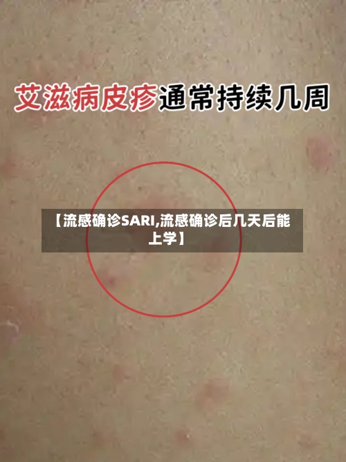 【流感确诊SARI,流感确诊后几天后能上学】
