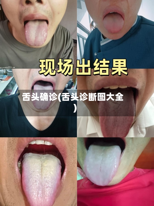 舌头确诊(舌头诊断图大全)