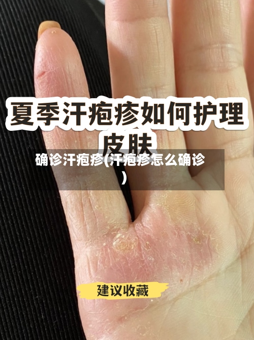确诊汗疱疹(汗疱疹怎么确诊)