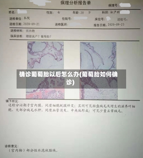 确诊葡萄胎以后怎么办(葡萄胎如何确诊)-第2张图片