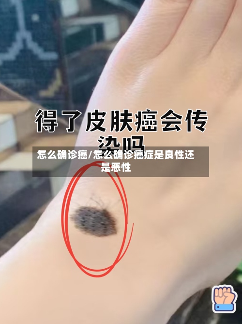 怎么确诊癌/怎么确诊癌症是良性还是恶性